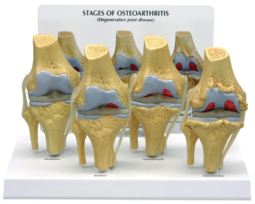 4-Stage Osteoarthritis Knee - Budget Model