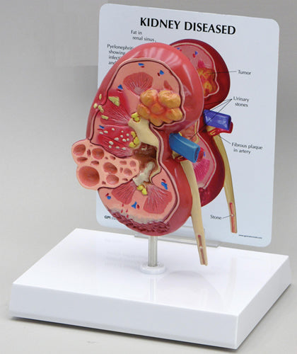Kidney Cancer Oversize - Budget Model