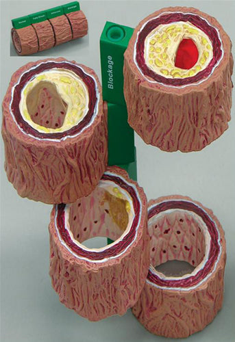 4-Piece Artery - Budget Model