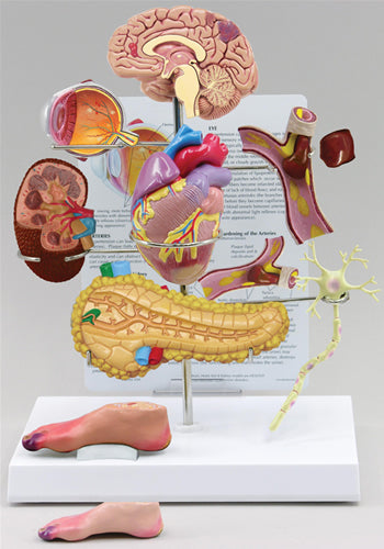 Type II Diabetes Set - Budget Model