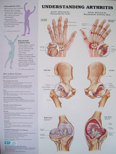Understanding Arthritis