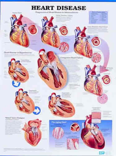 Heart Disease Chart