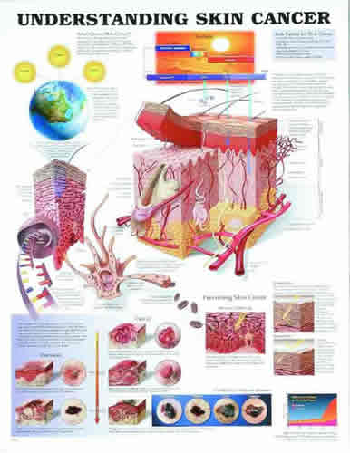 Understanding Skin Cancer Chart