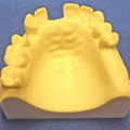 Partially Endentulous Maxilla