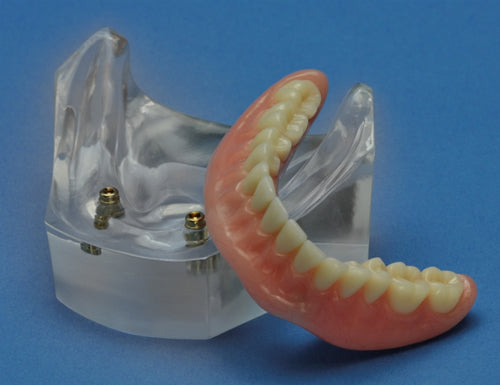 Dental Implant Overdenture Model with Two Locator Inserts