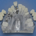 Hybrid Mandible