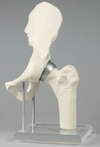 Hip Joint with Resurfacing Implant