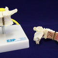 Vertebra Showing Arthritis And Osteoporosis