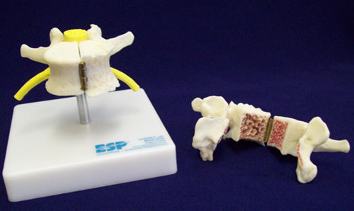 Vertebra Showing Arthritis And Osteoporosis