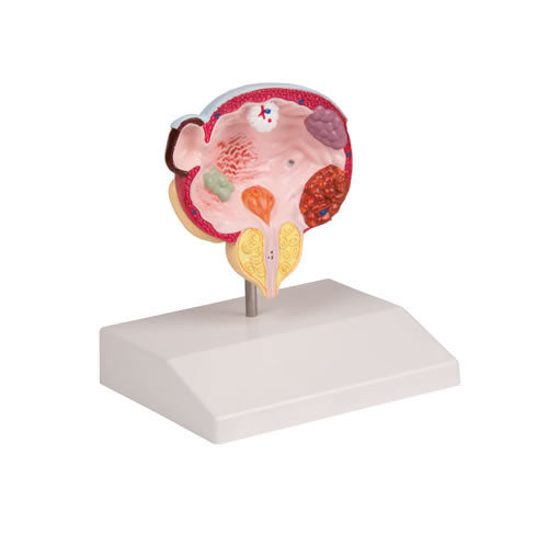 Diseases of the Urinary Bladder & Prostate