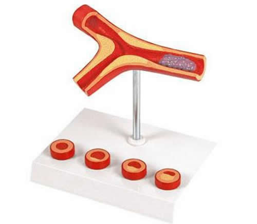 Atherosclerosis & Thrombosis Model